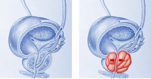 próstata sa e inflamada con prostatite